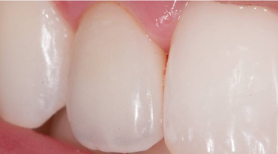 قبل تركيبات-اسنان